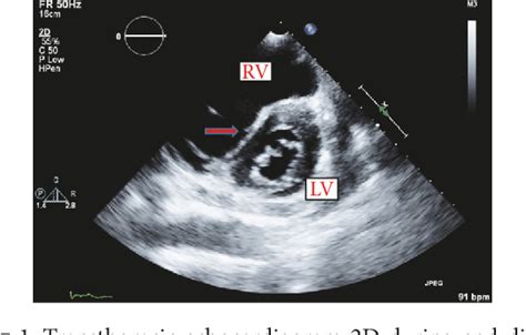 lv d shape|d shaped left ventricle function.